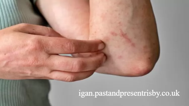 Cara Mengobati Bintik Merah pada Kulit Disertai Gatal