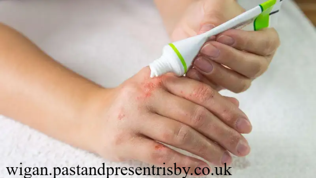 7 Obat - Obatan yang Cocok di Pakai untuk Penyakit Eksim